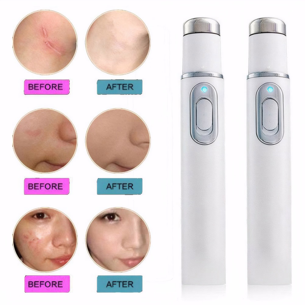 Pióro do terapii niebieskim św – Acne Light Therapy Pen recenzja i cena